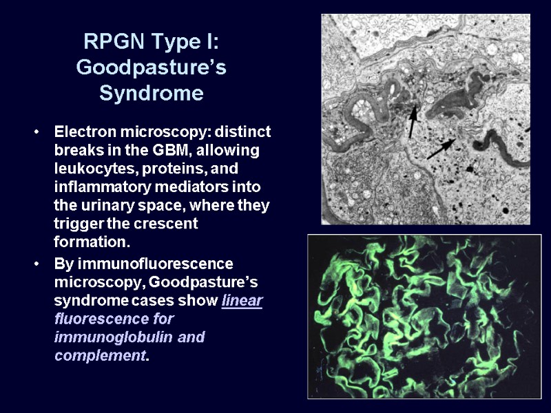 RPGN Type I: Goodpasture’s Syndrome Electron microscopy: distinct breaks in the GBM, allowing leukocytes,